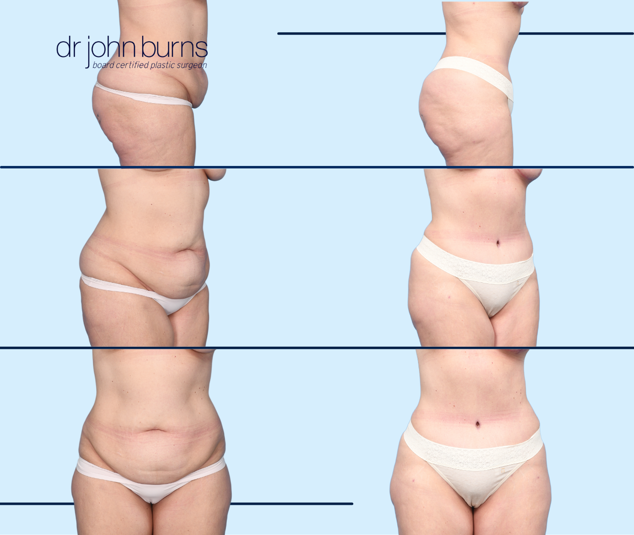 Before & After Hourglass Tummy Tuck by Dallas Plastic Surgeon, Dr. John Burns