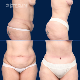 Before and After Liposuction in Dallas, Texas