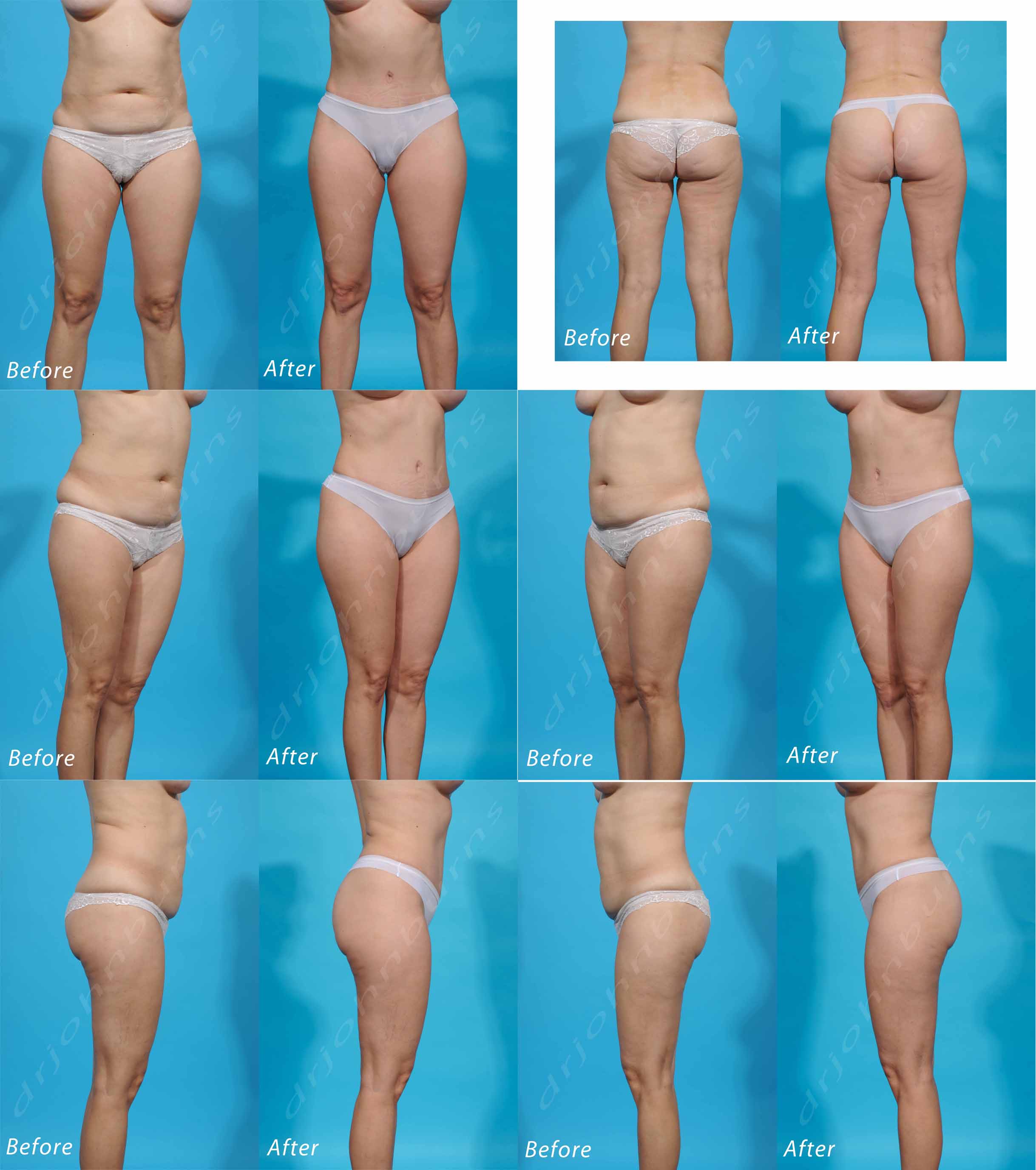 Mini Tummy Tuck/Abdominoplasty: Photo Gallery – Dr John Burns