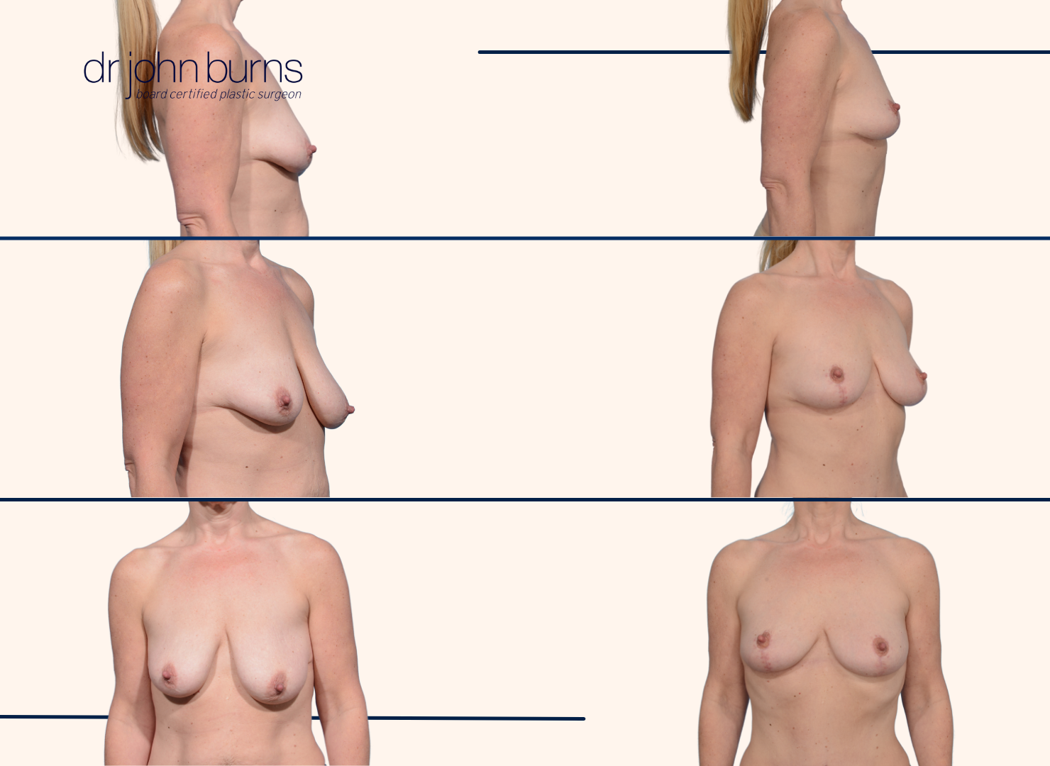 before and after anchor breast lift