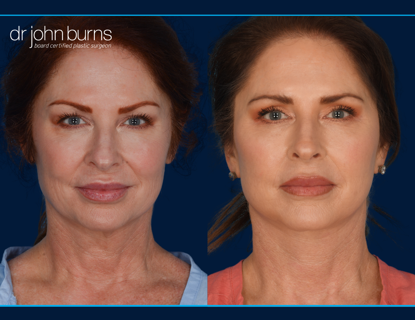 Facelift Before and After with Facial Fat Grafting | Dallas Facelift | Dr. John Burns