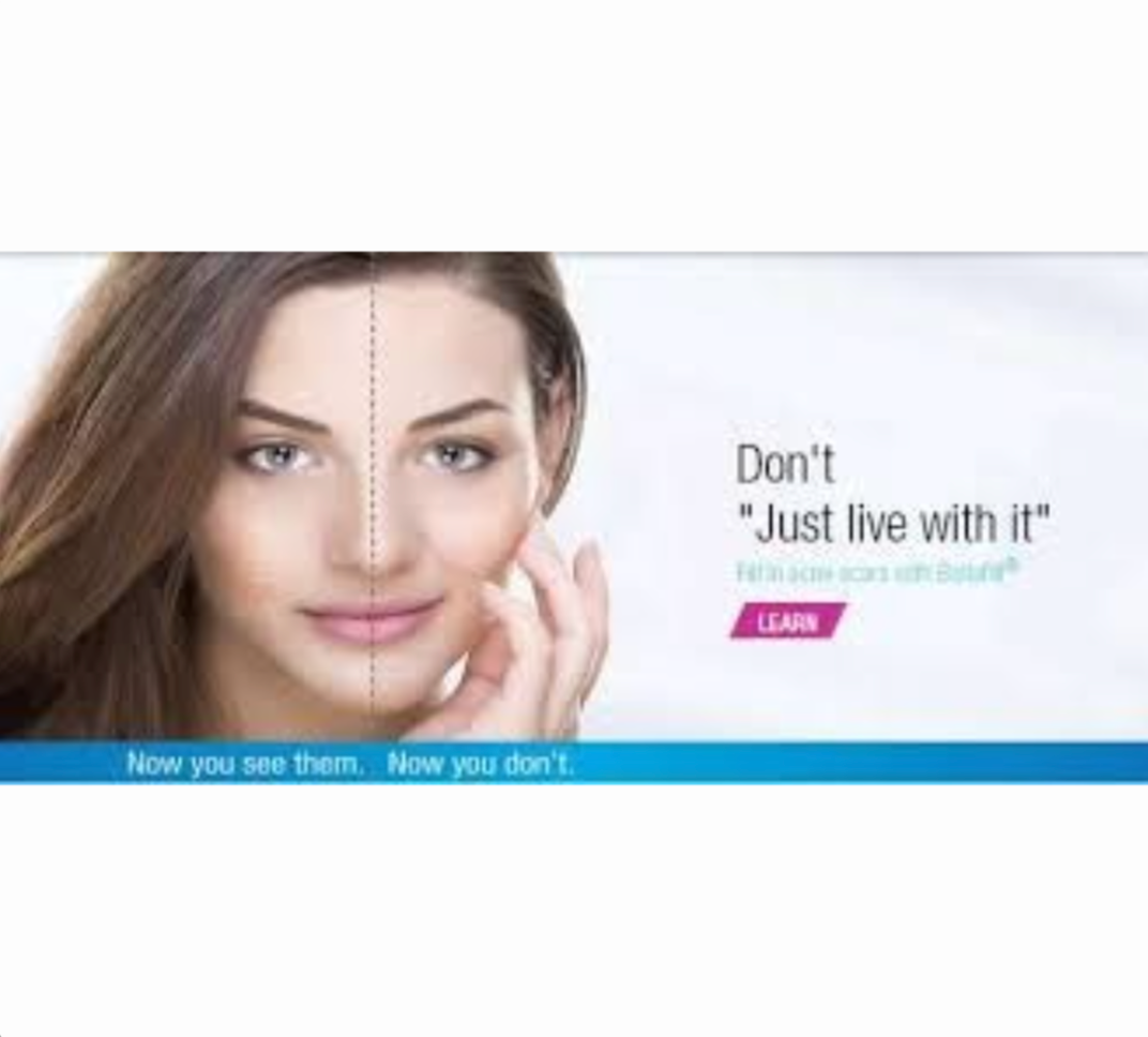 Advanced Treatment Options For Acne Scars.png__PID:d7745f8e-a261-42b1-93c4-ed48ff327ade