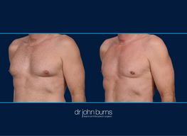Right Profile View | Before and After Male Chest Liposuction | Dallas, Liposuction