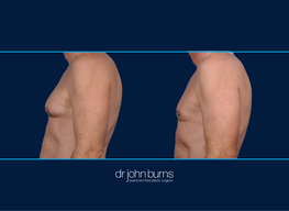 Left Profile View | Before and After Male Chest Liposuction | Dallas, Liposuction