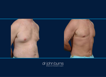 Before and After Male Liposuction to Chest, Abs, Flanks, Dallas Lipo by Dr. John Burns