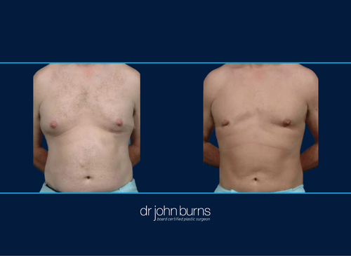 Before and After Male Liposuction to Chest, Abs, Flanks, Dallas Lipo by Dr. John Burns