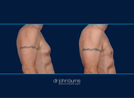 Right Profile View | Before and After Male Chest Liposuction | Dallas, Liposuction