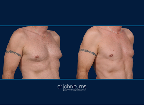 Before and After Male Chest Liposuction | Dallas, Liposuction