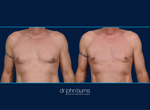 Before and After Male Chest Liposuction | Dallas, Liposuction