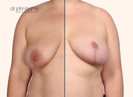 breast lift before and after with breast lift scars