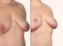 Breast lift before and after by Dr. John Burns