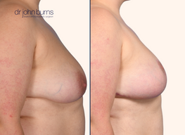 profile view before and breast lift by Dr. John Burns