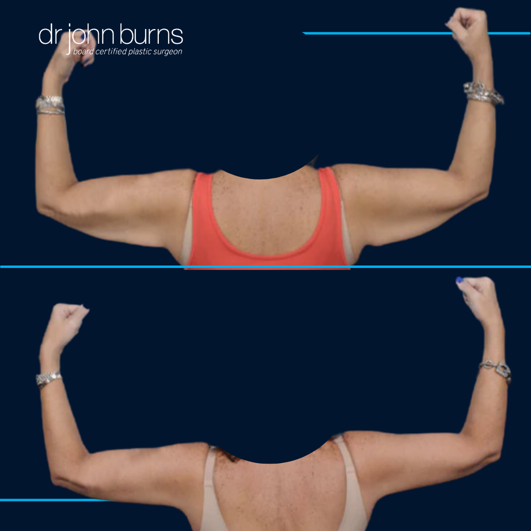 Arm Lift Before and After- Dallas, Texas.png__PID:2d5bd24a-2dd0-47c6-9e24-5492f6799dee