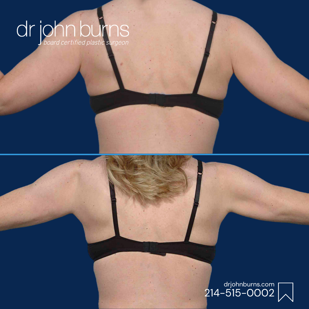 Arm Lift Before and After- Dr. John L. Burns.png__PID:440fc94c-8030-400c-9b38-4ee3ee265066