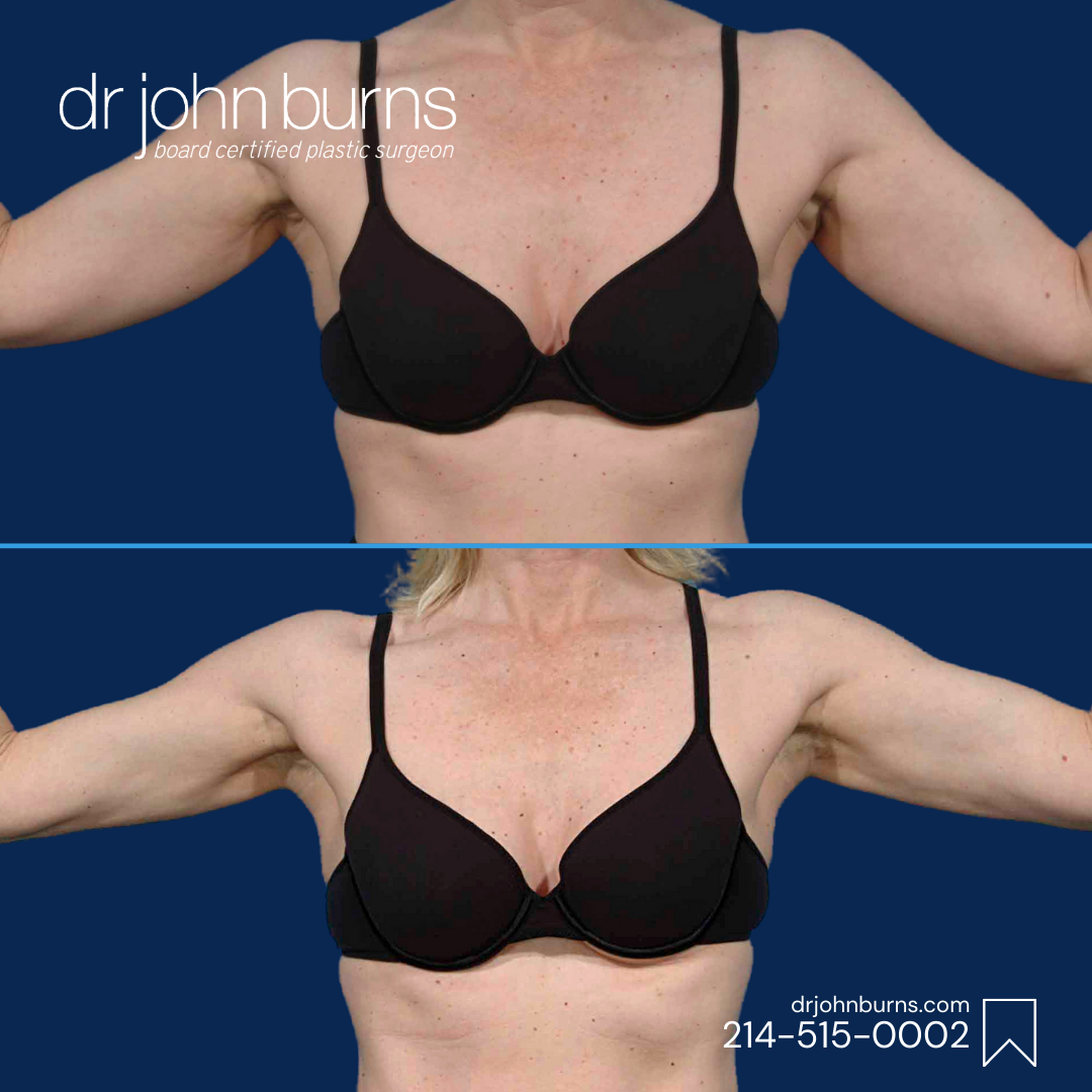 Arm Lift Before and after- Dr. John Burns.png__PID:0fc94c80-3050-4c1b-b84e-e3ee2650663d