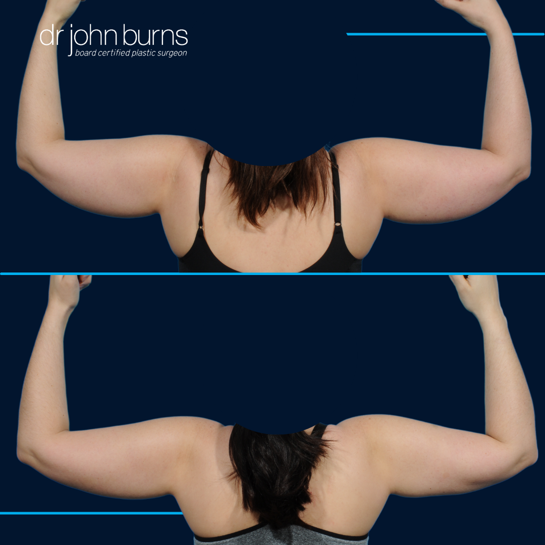 Arm Reduction with Lipo- Dr. John Burns.png__PID:f23260ed-f539-45bc-b7f1-a4558ad3adb8