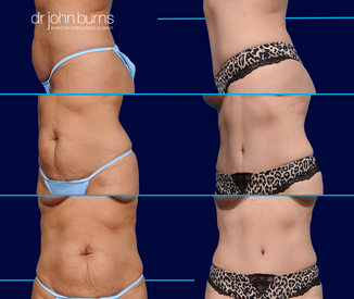 before and after tummy tuck surgery by Dallas Plastic Surgeon, Dr. John Burns