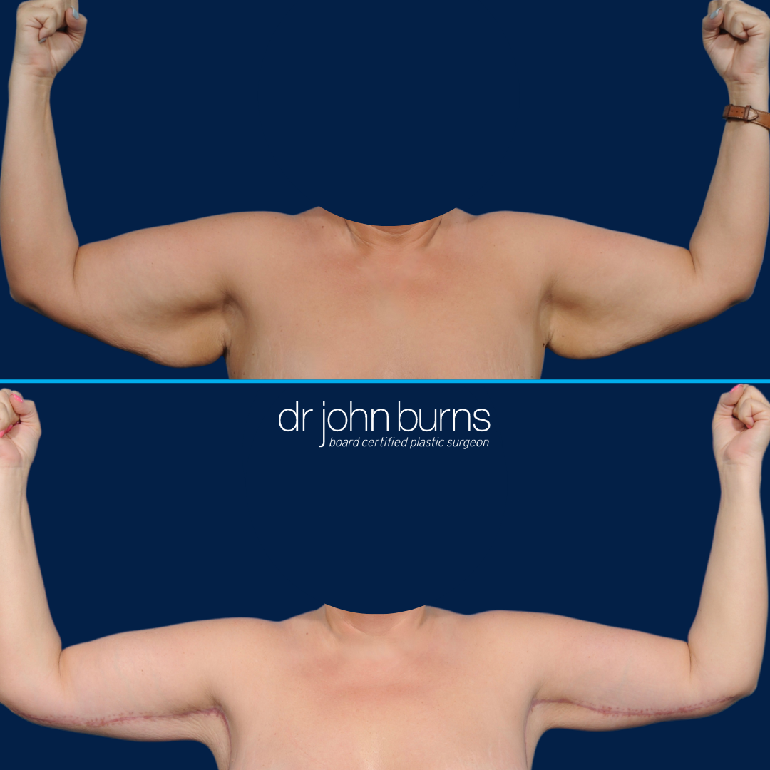 Before and After Arm Lift-Bracioplasty-Dr. John Burns.png__PID:2cc6b15a-513d-4566-abbd-26733f5fced0