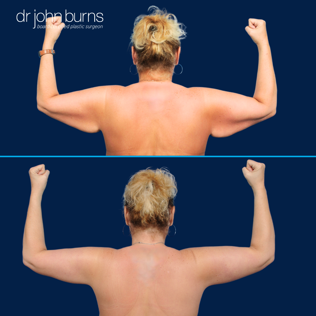 Before and After Arm Lift- Arm Lift Surgeon.png__PID:b82cc6b1-5a51-4d15-a66b-bd26733f5fce