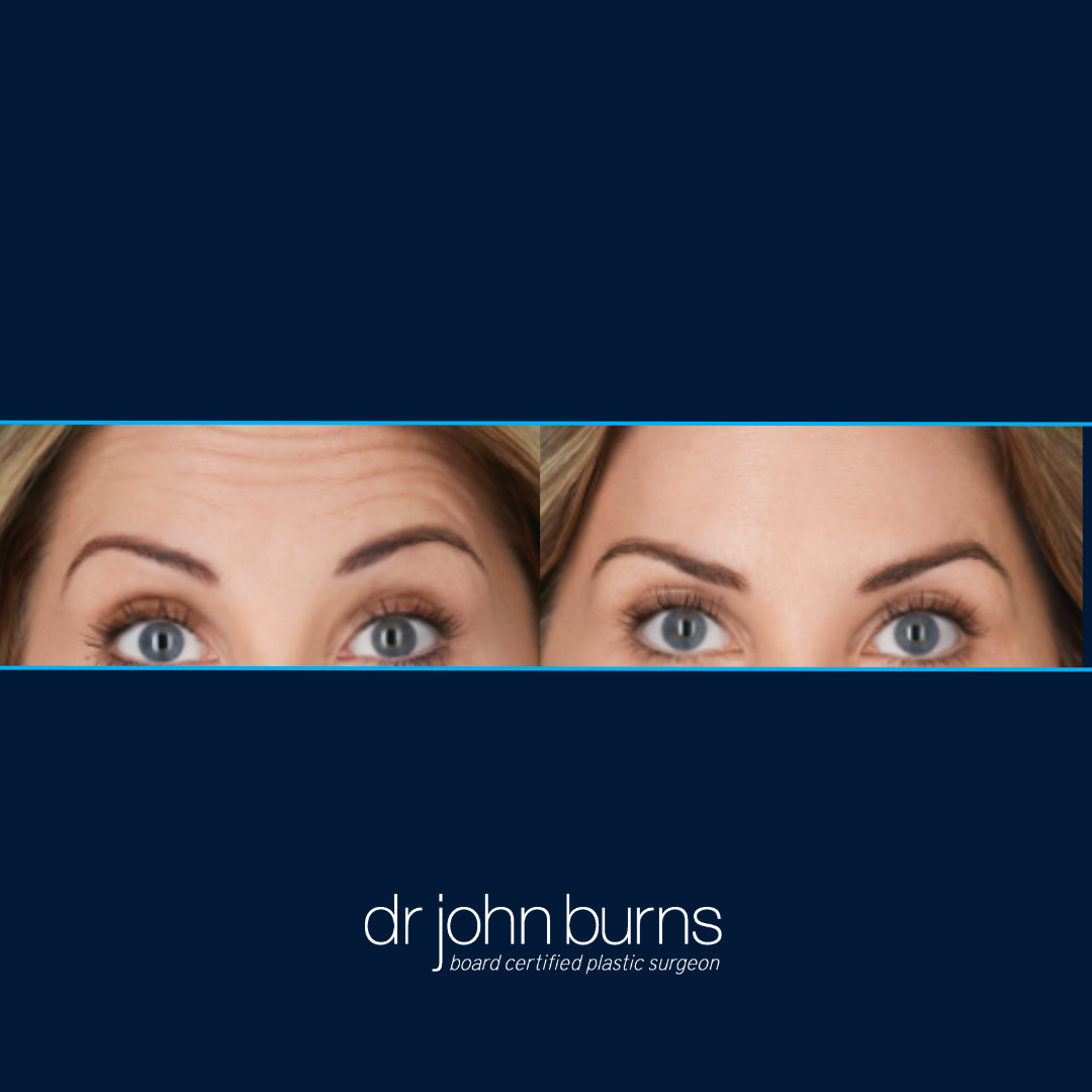 Before and After Botox Female in Dallas TX, Dr. John Burns.png