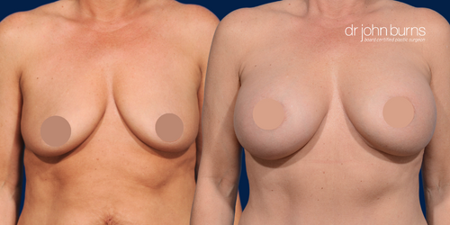 Before and After Breast Implants-Dallas,TX- Dr. John Burns.png__PID:055aed0c-3c8b-40e5-b692-184dc5f4e175