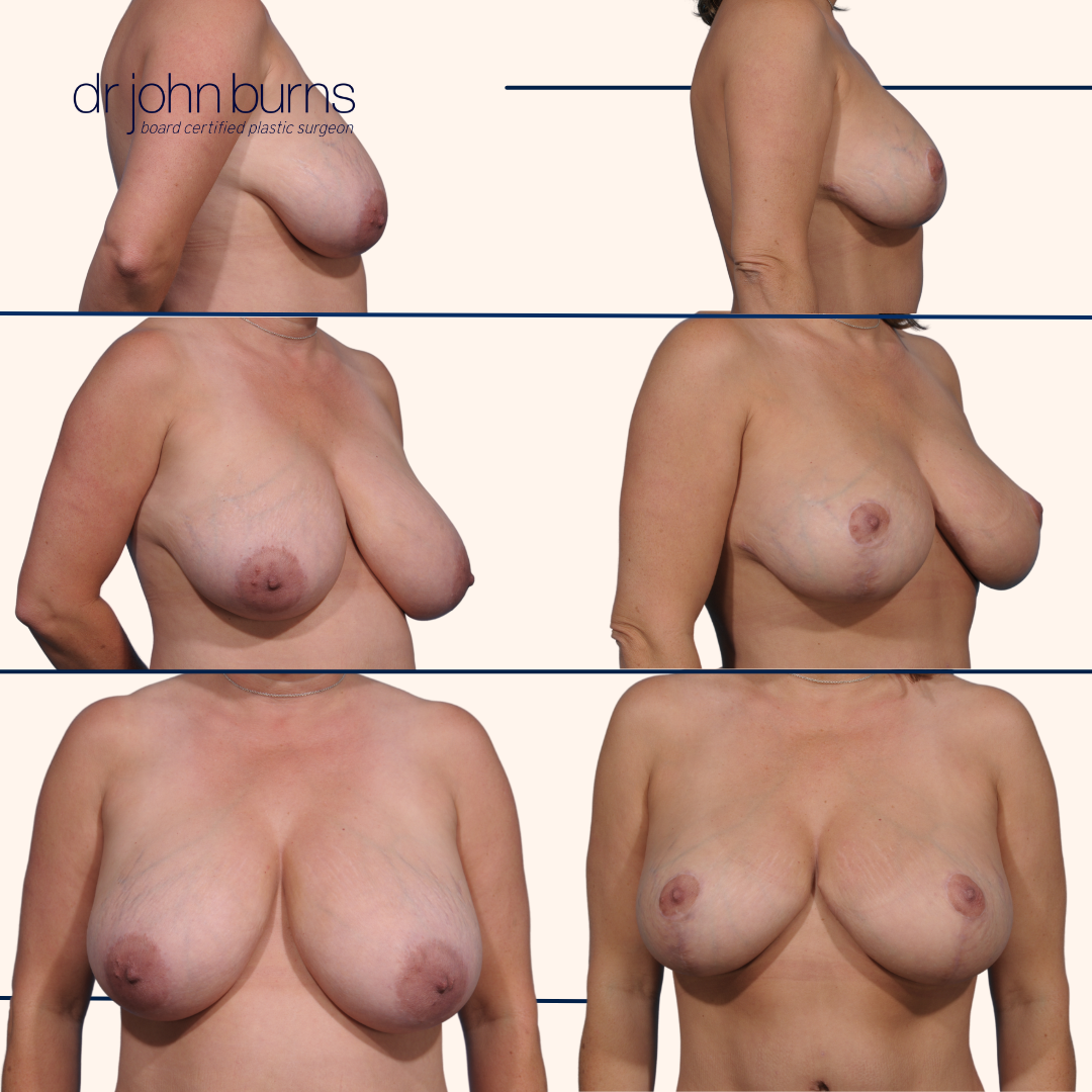Before and After Breast Reduction in Dallas, Texas- Dr. John Burns.png__PID:f48dadd2-2595-46e5-a091-9307e7ef87ee