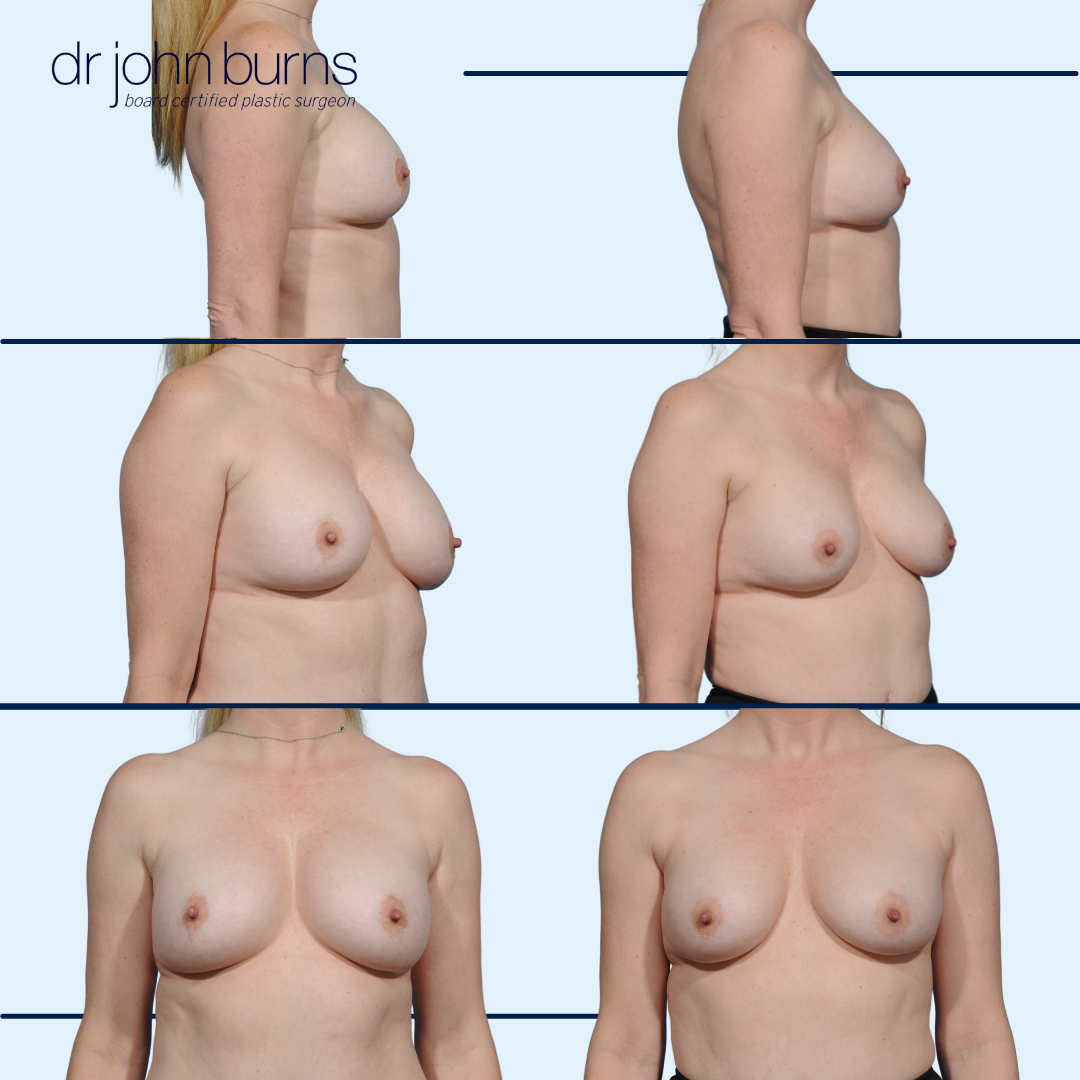 Before and After Explant with Fat Grafting by Dr.John Burns MD.png__PID:0d1cd76e-670e-453b-b046-37c6311e35c9