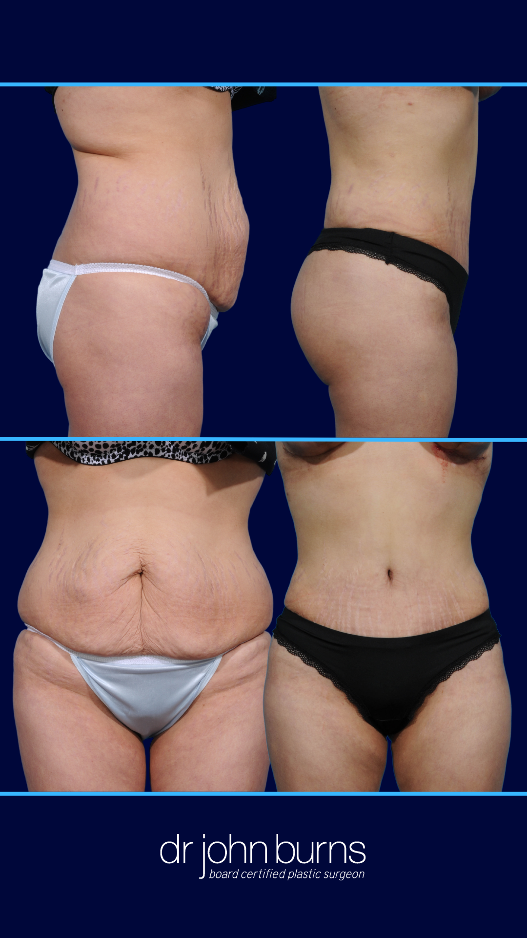 Extended Tummy Tuck Before and After- Dr. John Burns MD, Dallas, Texas