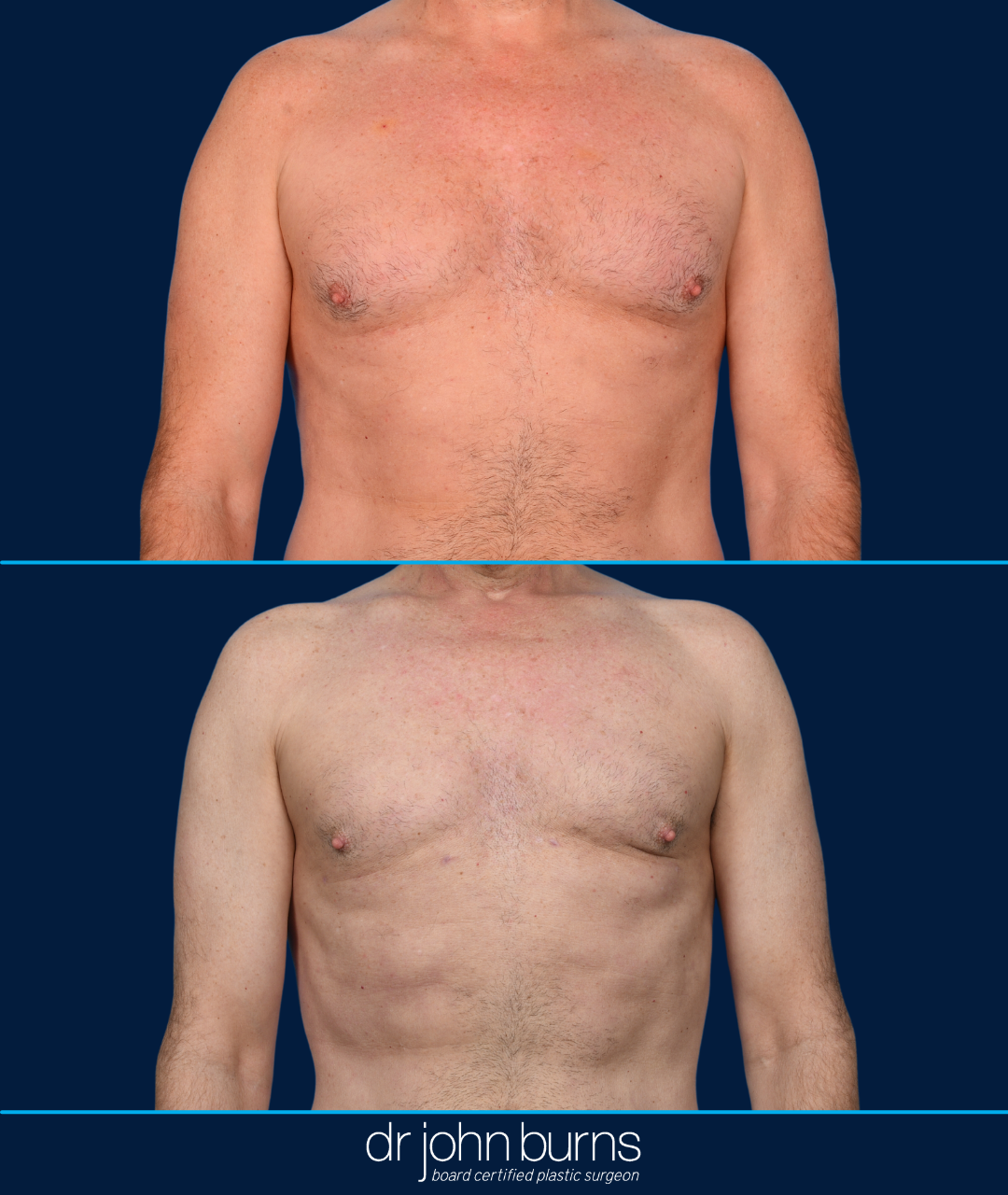 Before and After Male Chest Reduction by Dr. John Burns MD.png__PID:b3b1daf9-3609-4188-ad2a-dd62ab023503