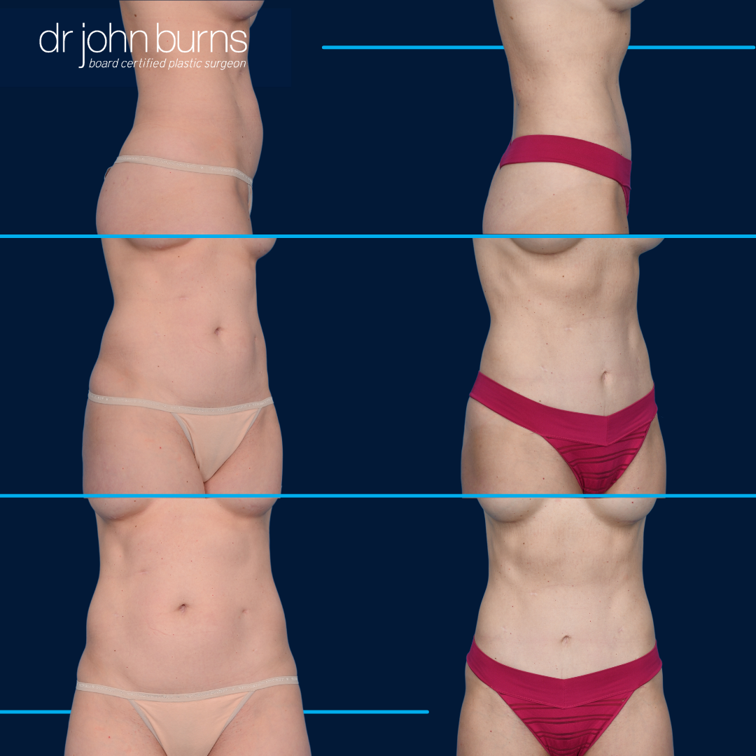 Best Mini Tummy Tuck- Dallas-Top Plastic Surgeon, Dr. John Burns