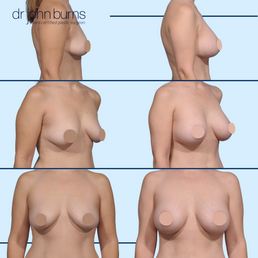 Before and After Silicone Breast Implants in Dallas, TX.png__PID:fba11c84-0393-4459-bfde-faaaf8c2ee1e
