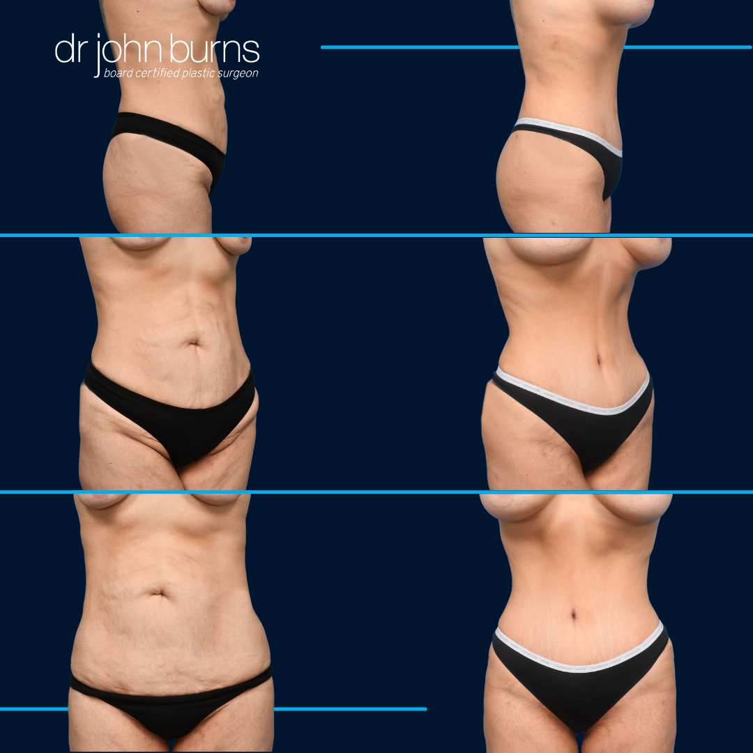 Before and After Tummy Tuck by Dr. John Burns.png__PID:5b2b8aec-a521-4e11-a923-2483c26c8564