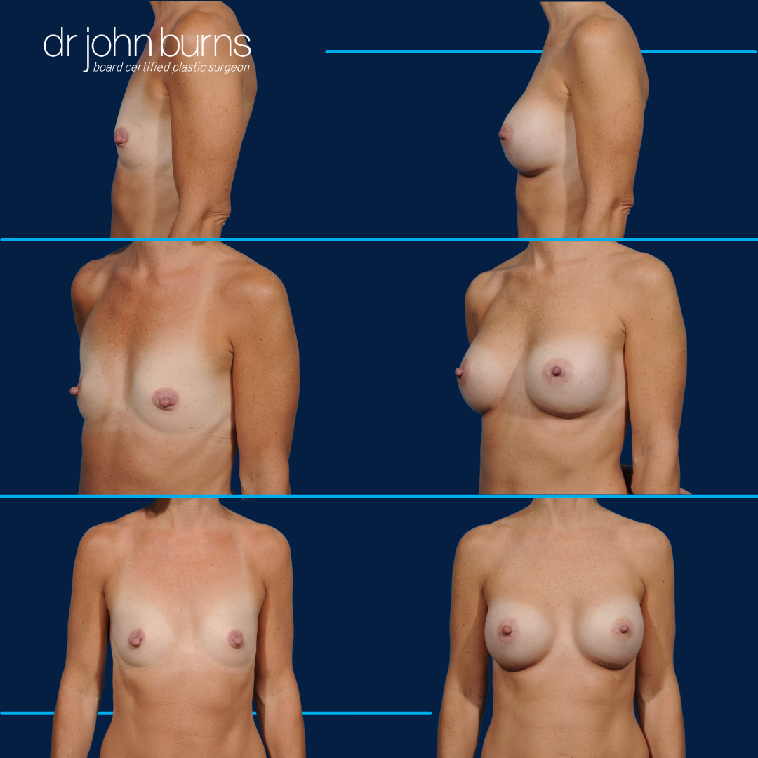 Before and after breast augmentation by Dr. John Burns MD in Dallas, Texas.png__PID:0d577f3f-e3bc-4e0d-a347-600d3ff6c42f