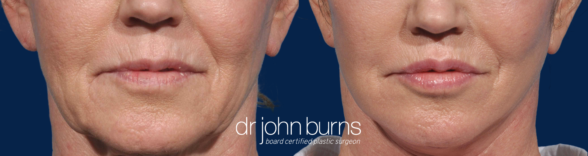 lip lift surgery by Dr. John Burns