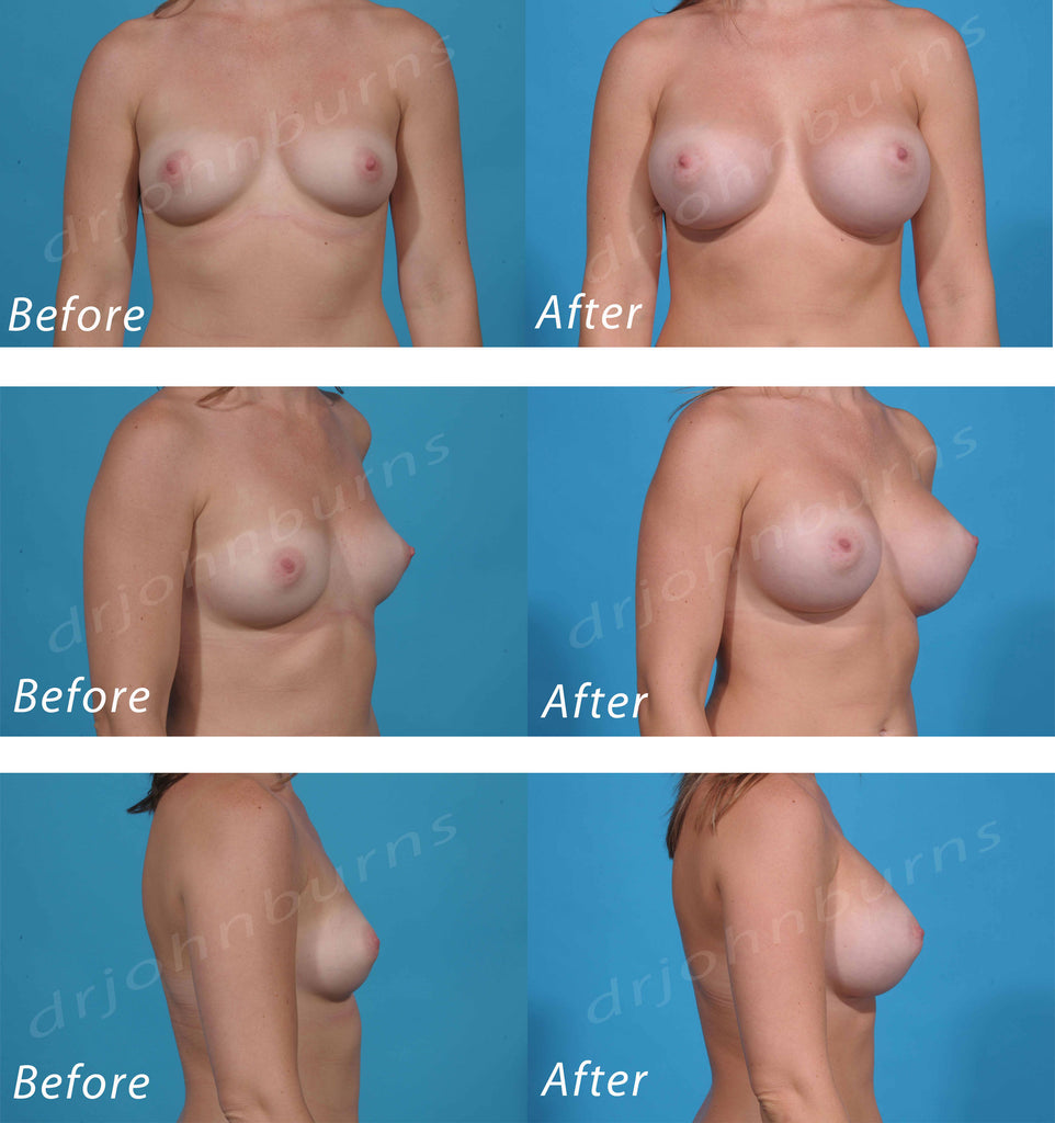 Breast Augmentation B to D – Dr John Burns