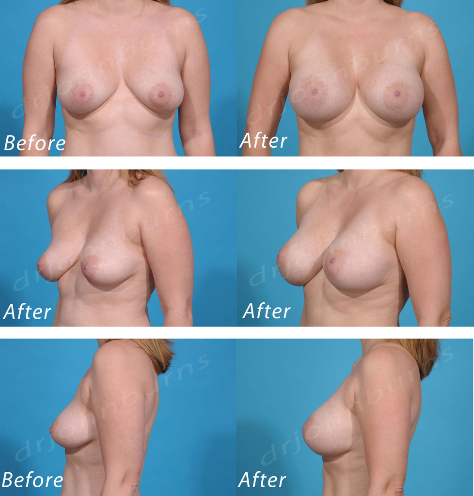 Breast Augmentation: B to D – Dr John Burns