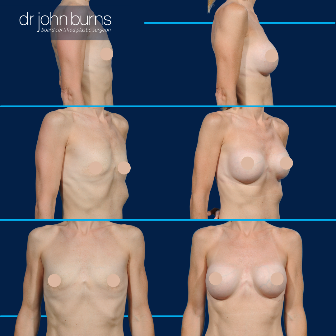 subfascial breast augmentation, natural breast augmentation results for athletic women