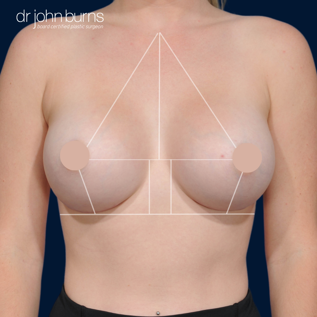 Breast Augmentation Measurements- Base Diameter- Dallas, TX.png__PID:1a537a4a-b5c1-4f3b-9ca5-28042ca7e73d