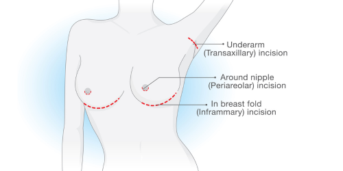Breast Augmentatnion Incision Sites.png__PID:4a5a58e1-bc9e-4ddb-a58b-2effd74a9fa7