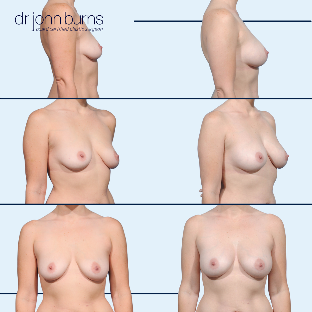 Breast Implant Removal with Immediate Fat Transfer- Dr. John Burns- Dallas, Texas.png__PID:486d1c74-0243-4f90-ab46-f0822fdd2d6a