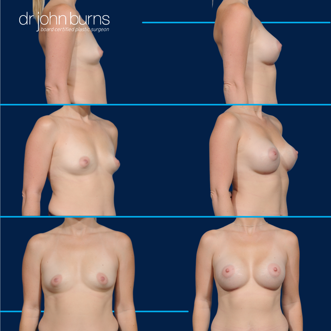 Breast Implants- Before & After- Dr. John Burns MD- Dallas Texas.png__PID:c3c16086-0706-408f-b77a-9161ff8ec2cf