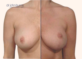 breast lift before and after with scars
