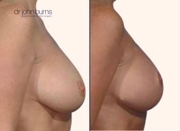 breast lift before and after, profile view