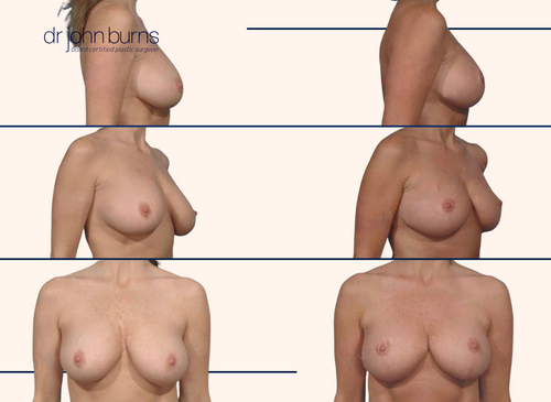 breast lift before and after with implant 
