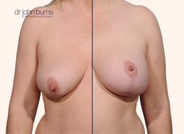 before and after breast lift with breast lift scar