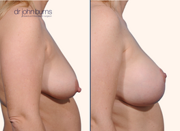 Before and after breast lift surgery by Dr. John Burns