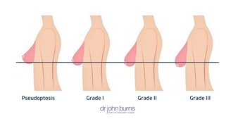 Breast Ptosis Classifications.png__PID:7e536ad5-e2e0-4d3e-8d6b-fcbdec2640ca