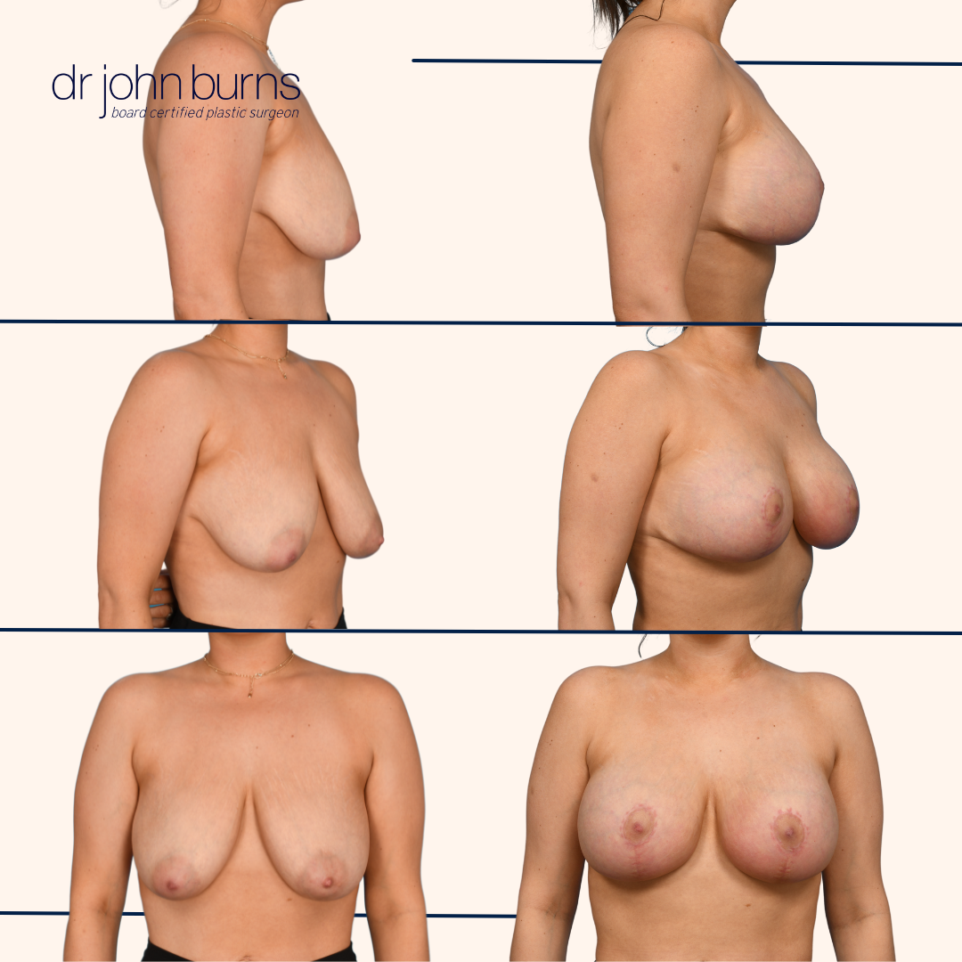 Breast Reduction Dallas, Texas- Dr. John Burns.png__PID:50793ce2-f48d-4dd2-a595-06e5a0919307