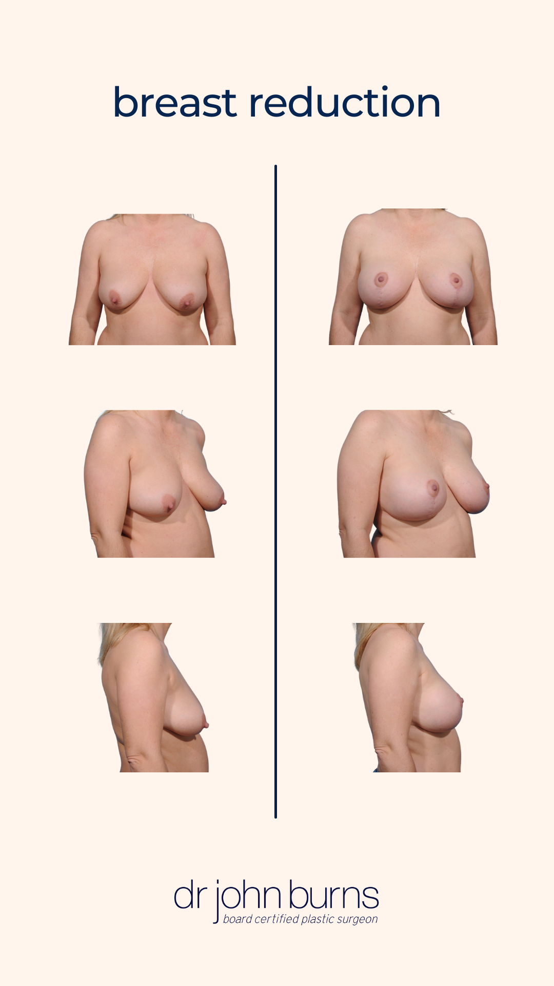 Breast Reduction in Dallas, Texas2.png__PID:06e5a091-9307-47ef-87ee-5ac3890e1f30