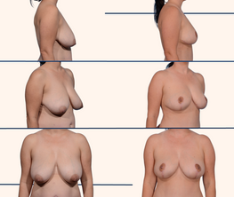 Before and After tummy tuck, Dallas Texas, Dr. John Burns